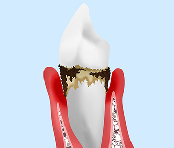 中等度歯周炎（歯周ポケット：4~7mm）