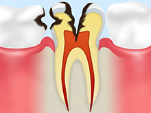 歯髄にまで達したむし歯（C3）